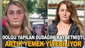 Dolgu yapılan dudağını kaybetmişti, artık yemek yiyebiliyor