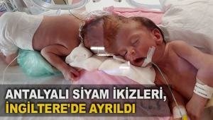 Antalyalı siyam ikizleri, İngiltere'de ayrıldı