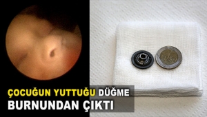 Çocuğun yuttuğu düğme burnundan çıktı