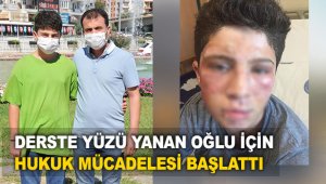 Derste yüzü yanan oğlu için hukuk mücadelesi başlattı