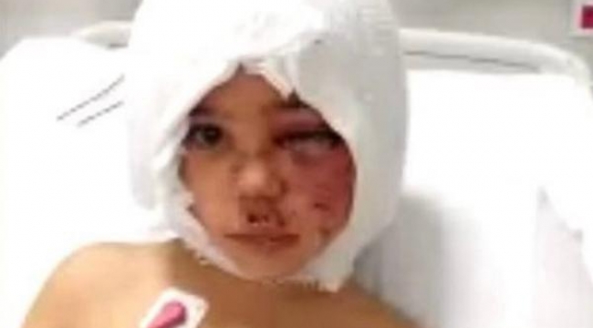 Asiye'nin kulaktaki hasarı ve yüz sinirlerine yönelik ameliyat yapıldı