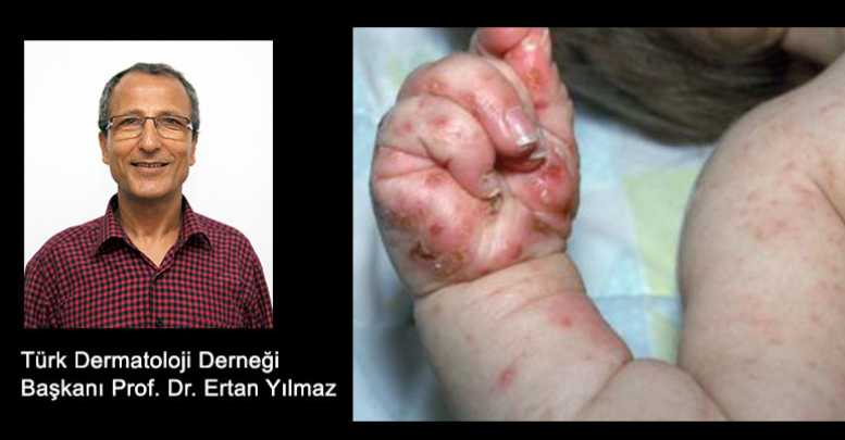 Uyuz korkulacak bir hastalık değil